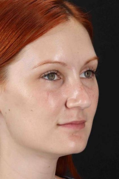 Lower Blepharoplasty Before & After Patient #2409