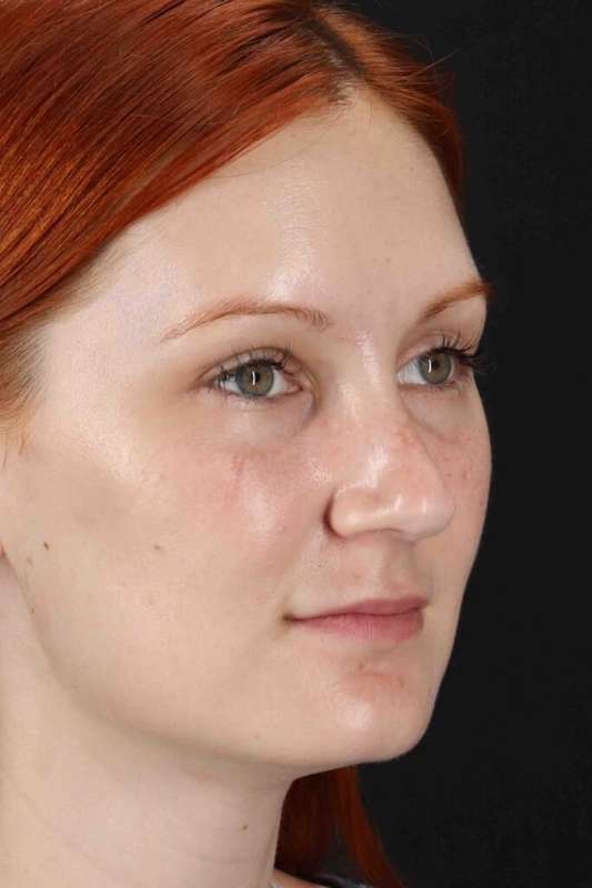 Lower Blepharoplasty Before & After Patient #2409