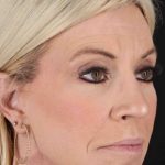 Neck Lift Before & After Patient #2430