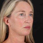 Neck Lift Before & After Patient #2441