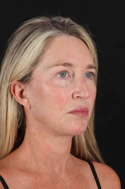 Neck Lift Before & After Patient #2441
