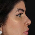 Browlift Before & After Patient #1220