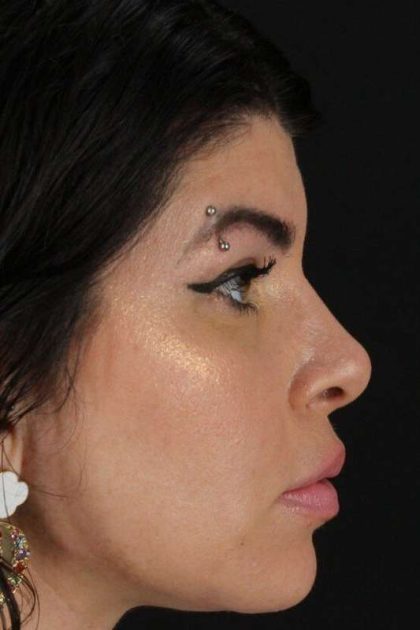 Browlift Before & After Patient #1220