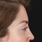 Browlift Before & After Patient #1319