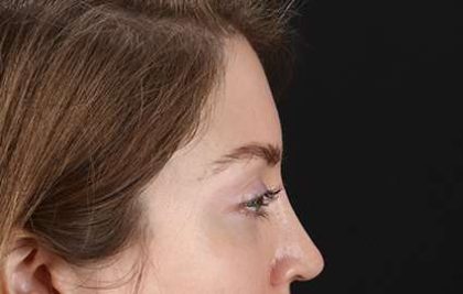 Browlift Before & After Patient #1319