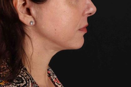 Neck Lift Before & After Patient #2472