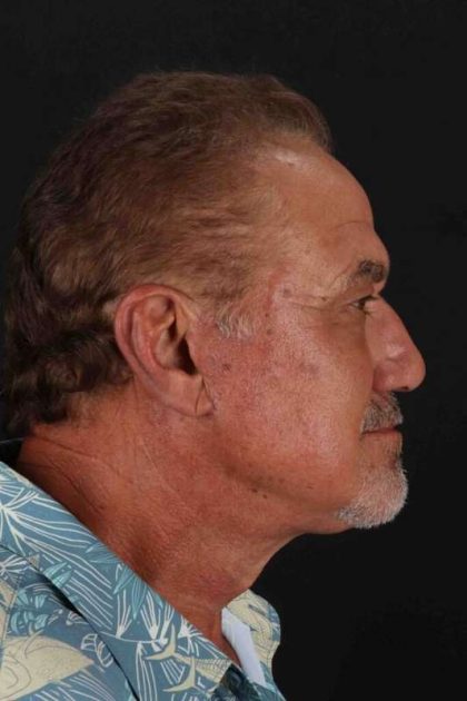 Neck Lift Before & After Patient #2483