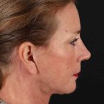 Neck Lift Before & After Patient #2494