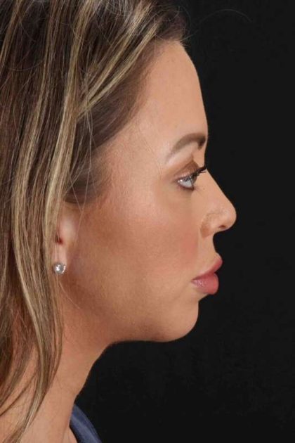 Neck Lift Before & After Patient #2505