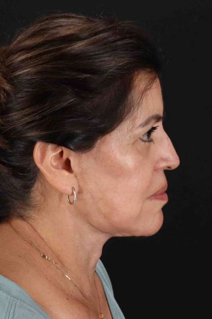 Neck Lift Before & After Patient #2516
