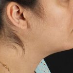 Neck Lift Before & After Patient #2560