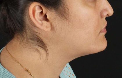 Neck Lift Before & After Patient #2560