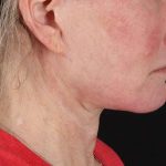 Neck Lift Before & After Patient #2571