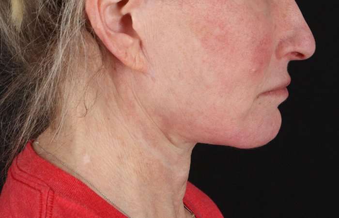 Neck Lift Before & After Patient #2571