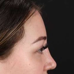 Browlift Before & After Patient #1330