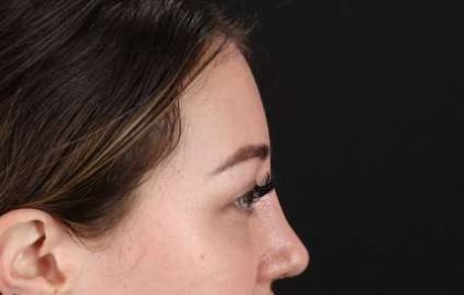 Browlift Before & After Patient #1330