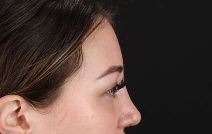 Browlift Before & After Patient #1330