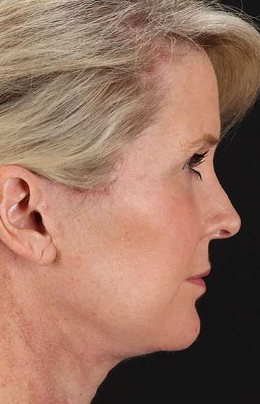 Neck Lift Before & After Patient #2582