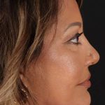 Neck Lift Before & After Patient #2593