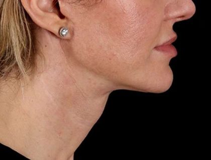 Neck Lift Before & After Patient #2626