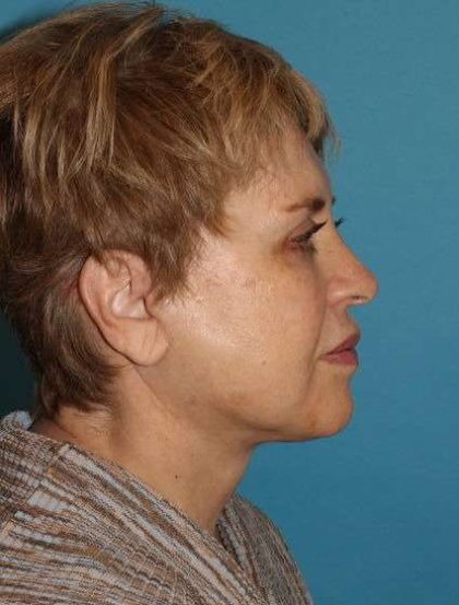Neck Lift Before & After Patient #2680