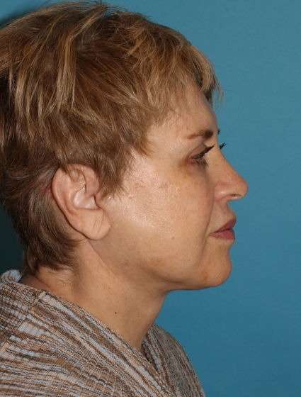 Neck Lift Before & After Patient #2680
