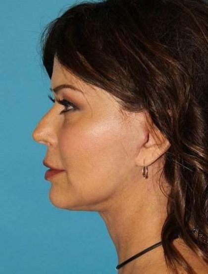 Neck Lift Before & After Patient #2699