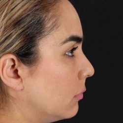 Browlift Before & After Patient #1341
