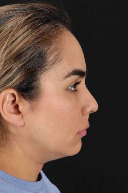 Browlift Before & After Patient #1341