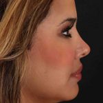 Neck Liposuction Before & After Patient #2708