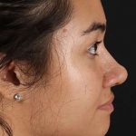 Neck Liposuction Before & After Patient #2730