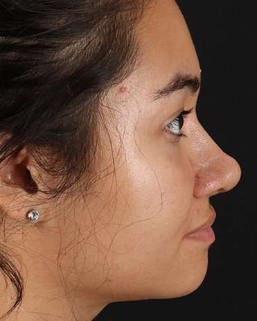 Neck Liposuction Before & After Patient #2730
