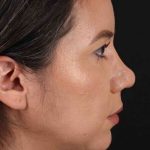 Neck Liposuction Before & After Patient #2741