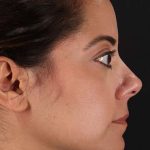 Neck Liposuction Before & After Patient #2752