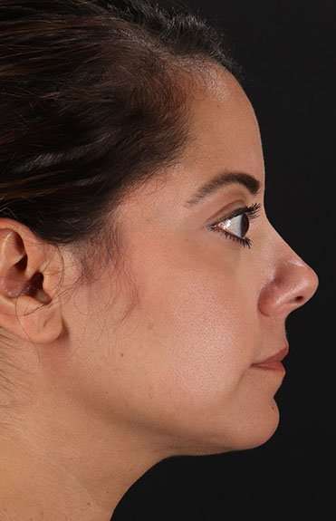 Neck Liposuction Before & After Patient #2752