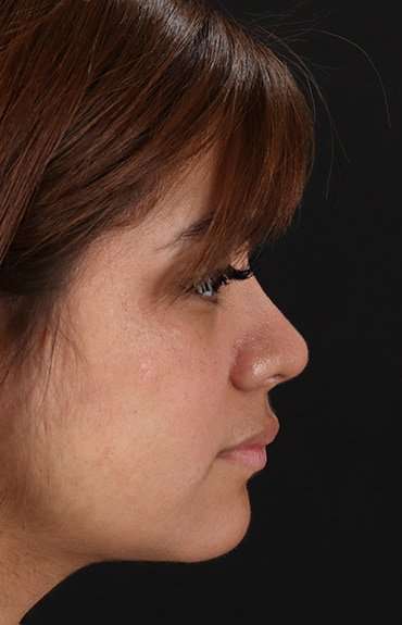 Neck Liposuction Before & After Patient #2763