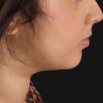 Neck Liposuction Before & After Patient #2774