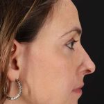 Neck Liposuction Before & After Patient #2785