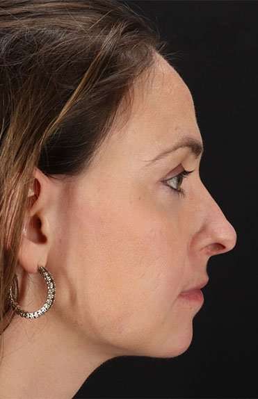 Neck Liposuction Before & After Patient #2785