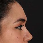 Browlift Before & After Patient #1352