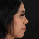 Rhinoplasty Before & After Patient #2818