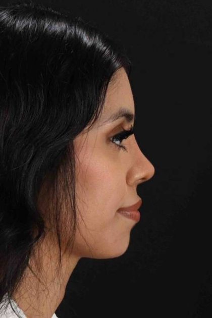 Rhinoplasty Before & After Patient #2818