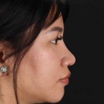 Rhinoplasty Before & After Patient #2829