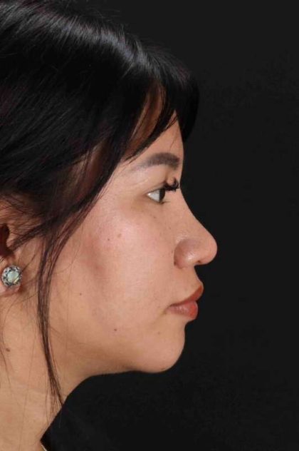 Rhinoplasty Before & After Patient #2829