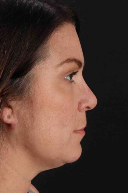 Rhinoplasty Before & After Patient #2851