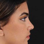 Rhinoplasty Before & After Patient #2862