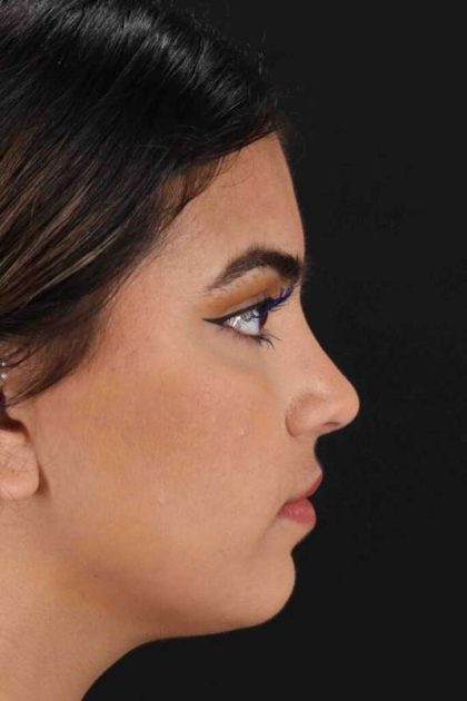 Rhinoplasty Before & After Patient #2862