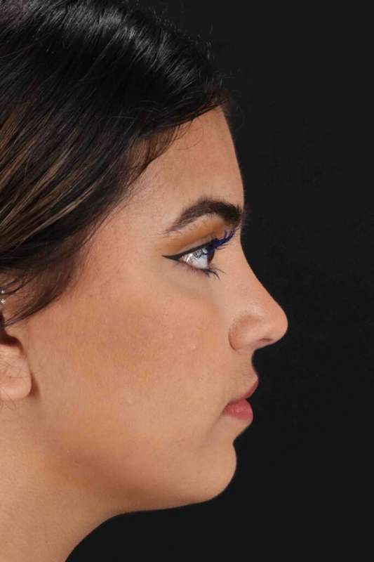 Rhinoplasty Before & After Patient #2862