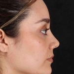 Rhinoplasty Before & After Patient #2873