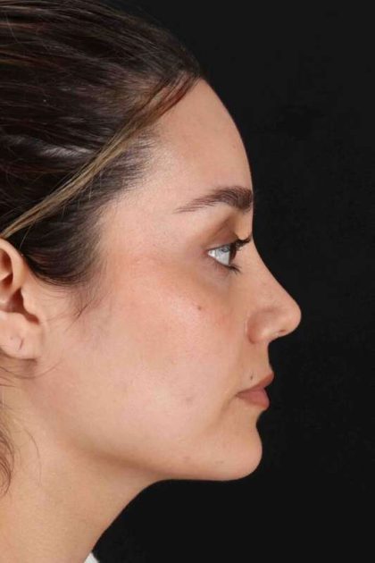 Rhinoplasty Before & After Patient #2873
